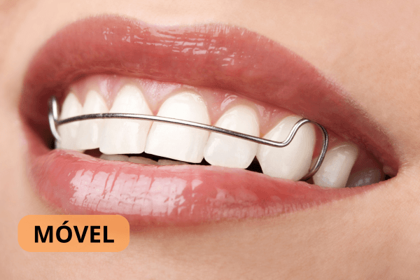 Close-up de um sorriso com aparelho móvel de contenção.