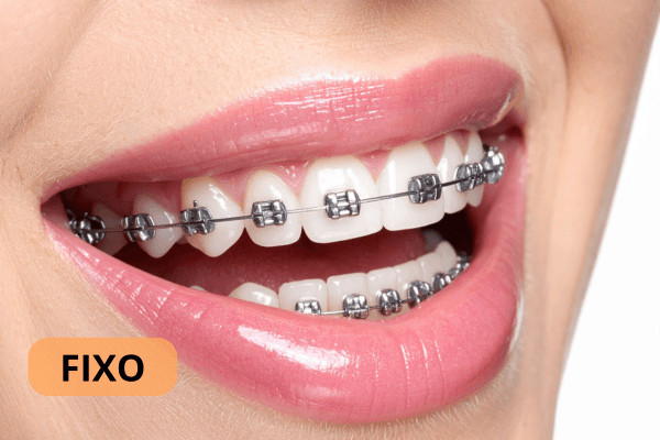 Sorriso de uma mulher com aparelho ortodôntico metálico.